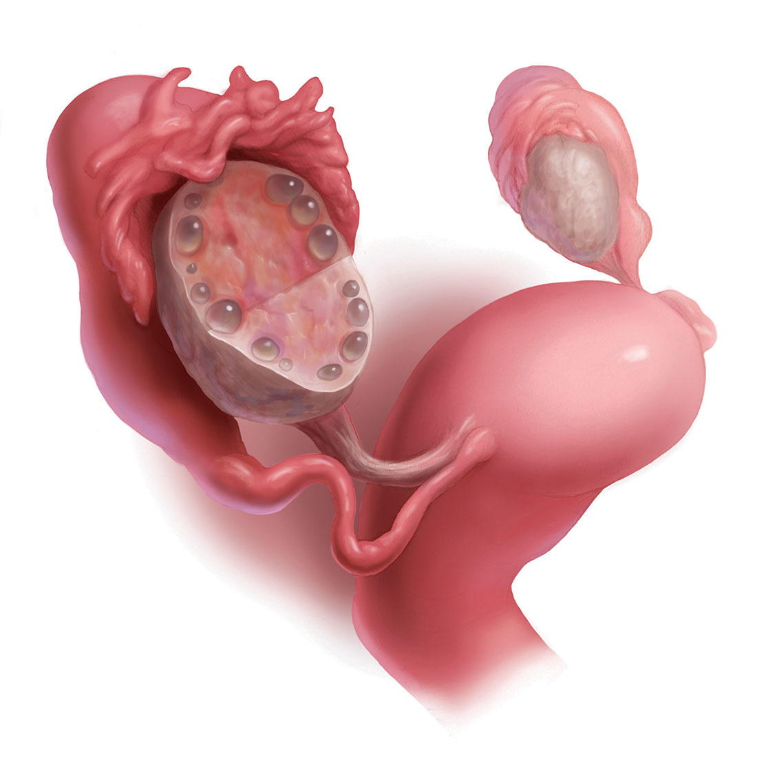 Integra Cirurgia - A remoção de um ou dos dois ovários, chama-se