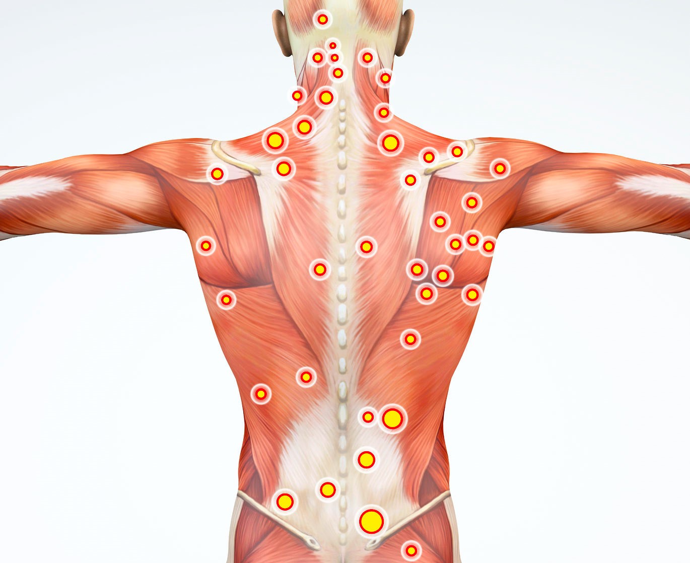 FIBROMIALGIA